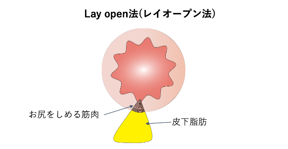 結紮切除術(LE法)_イラスト