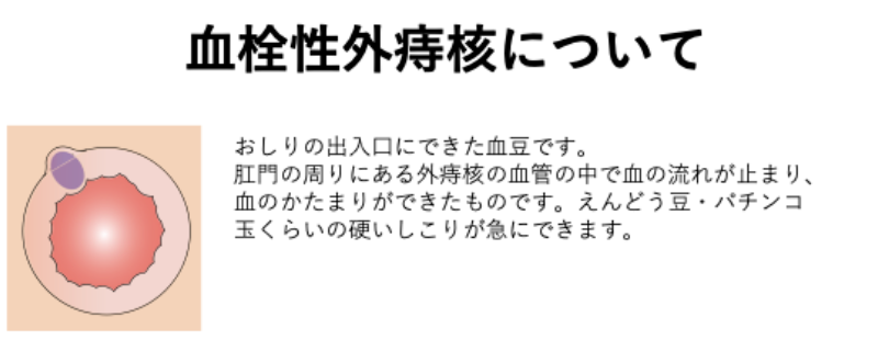 血栓性外痔核について_イラスト