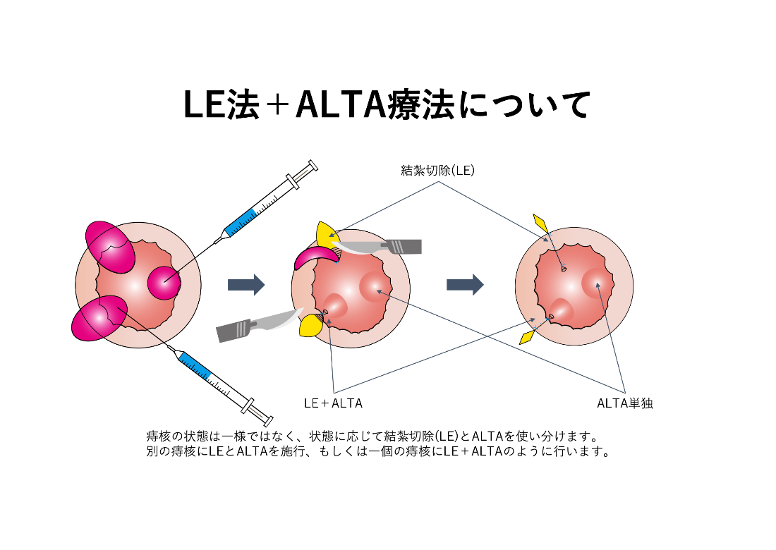 LE法＋ALTA療法_イラスト
