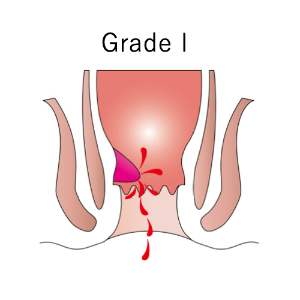 内痔核の分類_イラスト.01