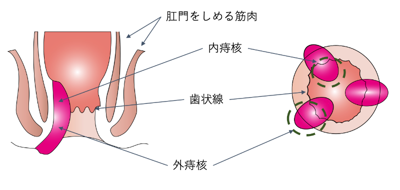 痔核_イラスト.02