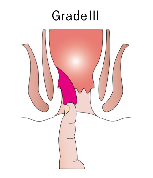 内痔核の分類_イラスト.03