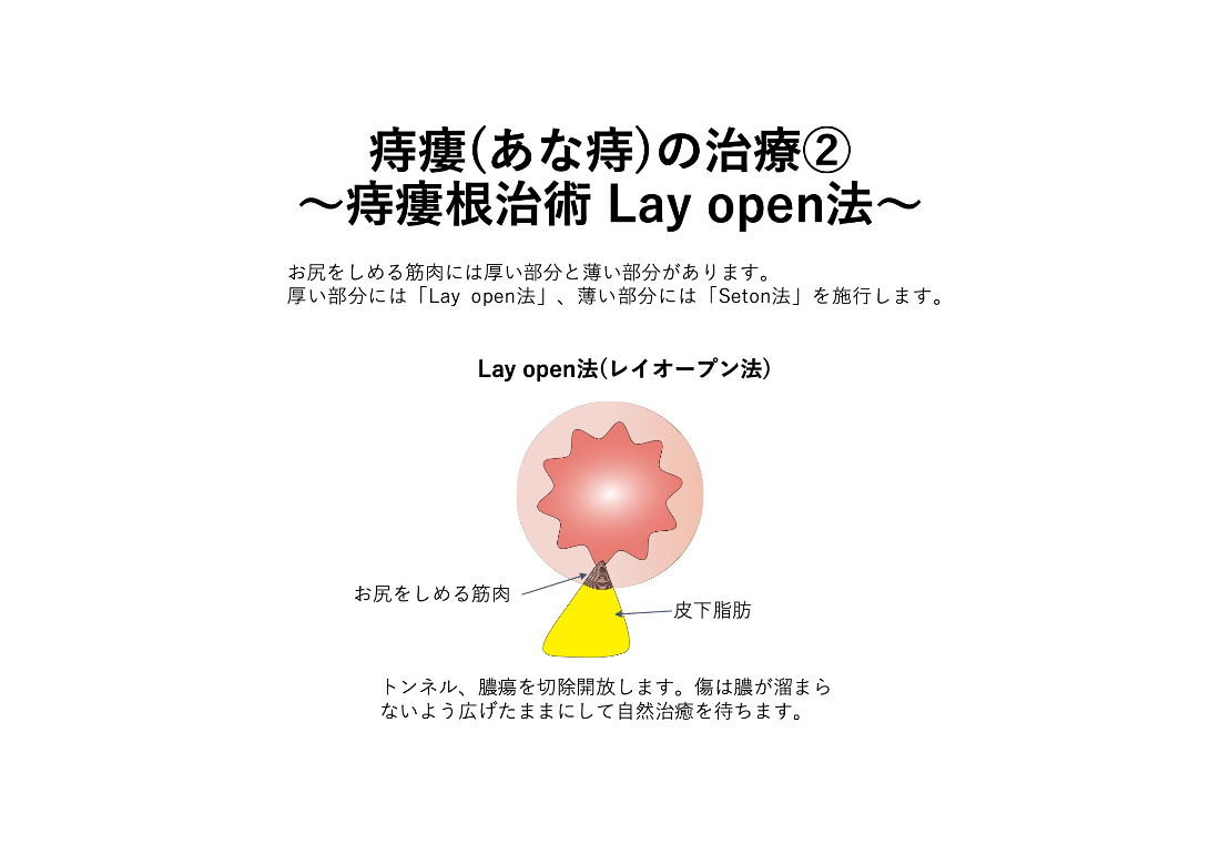 結紮切除術（LE法）_イラスト