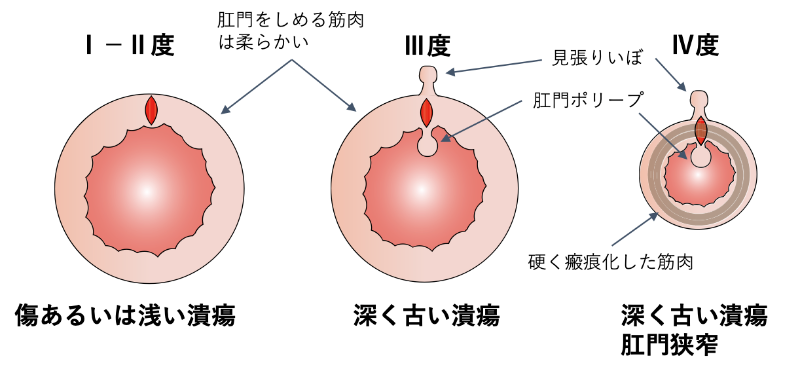 切れ痔について_解説イラスト
