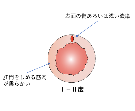 浅い切れ痔の治療_イラスト
