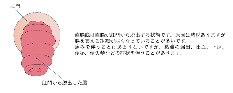 痔核_イラスト.02