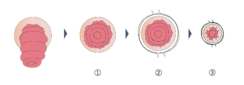 直腸脱の治療_チルシュ法_イラスト