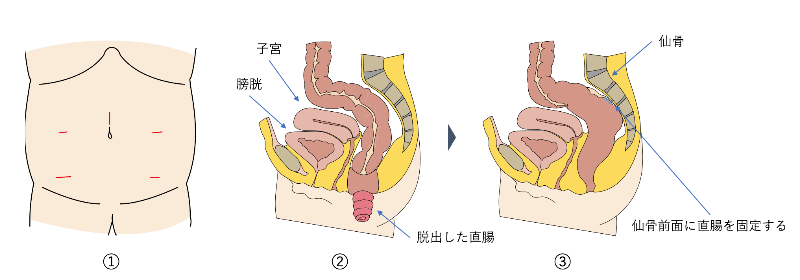 直腸脱の治療_腹腔鏡下直腸固定術_イラスト
